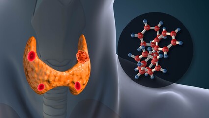 Hyperparathyroidism Disorder Affecting Human Body Hormones