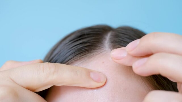 Young woman applying transparent round sticker to pimple on her face close-up on blue background.