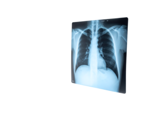 A frontal chest X-ray shows lungs, ribs, clavicles, and spine, revealing skeletal structure and lung tissue density