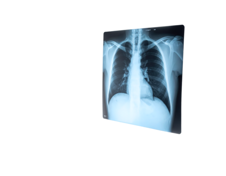 A frontal chest X-ray shows lungs, ribs, clavicles, and spine, revealing skeletal structure and lung tissue density