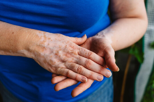 Close up of hands with vitiligo spots and blue shirt visible
