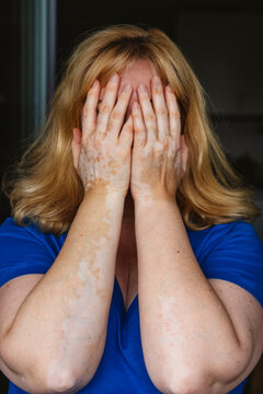Person with vitiligo covering face in blue clothing showing emotion