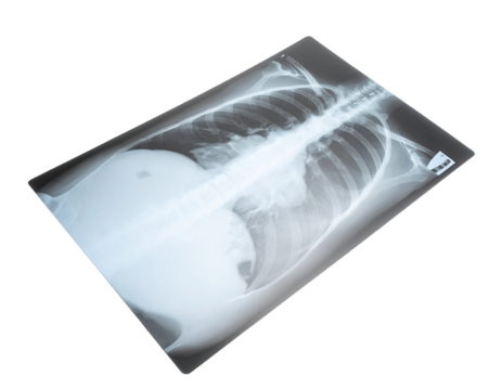 A grayscale X-ray image showing a human torso, spine, ribs, and lungs, slightly angled against a black background