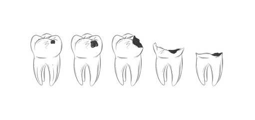 Life cycle of dental caries illustration drawing in graphic style with black on white background.