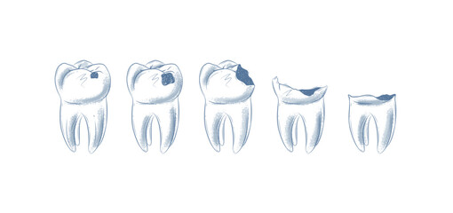 Life cycle of dental caries illustration drawing in graphic style with blue on white background.