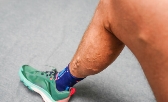 Varicose veins. Phlebology and DVT. Varicose veins on leg of man. Varicosity on legs, spider veins, edema, health illness concept. Phlebeurysm and thrombophlebitis of veins. Phlebology concept.