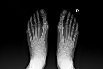 X-ray image of human feet showing bones, joints, toes and skeletal structure, useful for medical,...