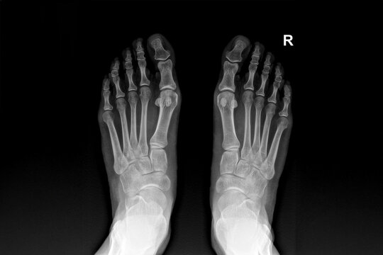 X-ray image of human feet showing bones, joints, toes and skeletal structure, useful for medical, healthcare, orthopedics, podiatry, anatomy, diagnostics, fracture examination and radiology education 