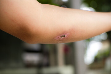 Naklejka premium A raw, open wound on a person's elbow, highlighting the pain and process of healing from an injury