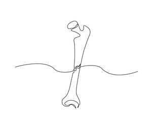 Broken bone outline illustration. Continuous line drawing of broken human bone.