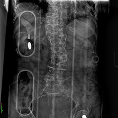 This image is an abdominal X-ray, a medical imaging test used to view the internal organs and structures within the abdomen.