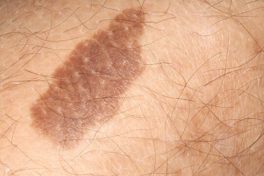 Macro view of human skin with birthmarks as background