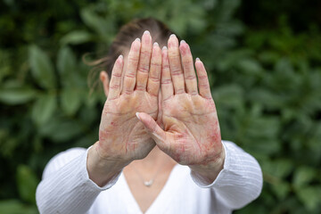 Skin conditions highlighted through hands showing signs of eczema and psoriasis in a natural outdoor setting