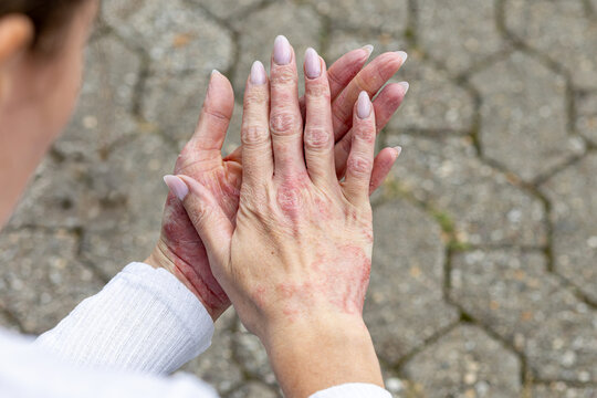 Skin condition on hands with visible eczema and psoriasis affecting daily life in an outdoor setting
