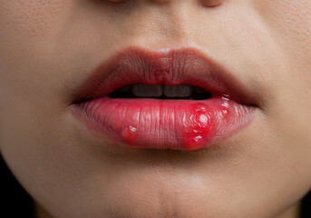 Lip Sore: Close-up on a person's lips with a noticeable sore, illustrating a common health concern and emphasizing the physical aspect of well-being.