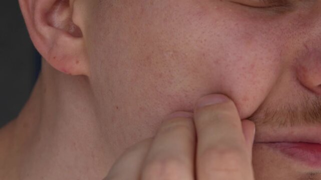 A man with a pimple on his face.
A guy squeezes a pimple on his face with his fingers.
Diathesis and skin rash, large pimple.
Allergy, diathesis, acne, inflammation, pus