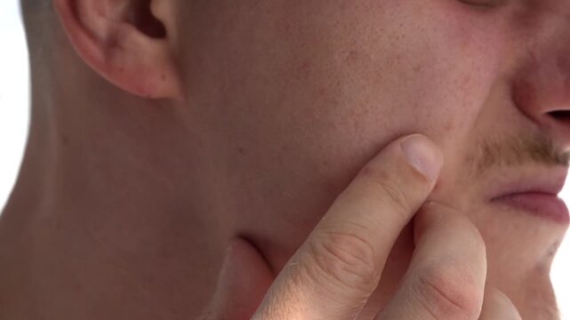 Acne and rash on the face of a young man.
The man picks at a pimple with his hands, doesn't practice good hygiene, and touches his face with his hands.
Rash and itching on the face.
Eczema, allergies