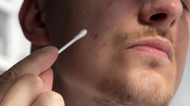 A man with a pimple on his face.
A guy squeezes a pimple on his face with his fingers.
Diathesis and skin rash, large pimple.
Allergy, diathesis, acne, inflammation, pus