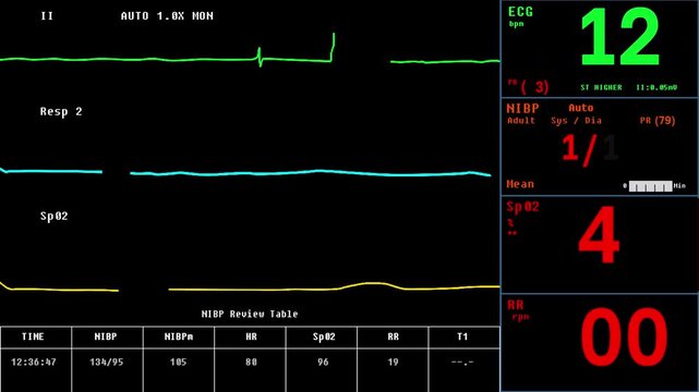 Heartbeat Monitoring Device Interface Shows Stabilizing Condition Of Patient. Heartbeat Monitoring Interface Detects Recovery Of Patient. Patients Heartbeat Improvement. ECG Monitoring Interface