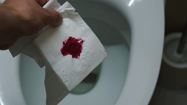 Blood stains on toilet paper.
Symptoms of hemorrhoids or cystitis.
Anal fissures and hemorrhoid inflammation.
Hemorrhoid enlargement in humans.
Blood drops on toilet paper.