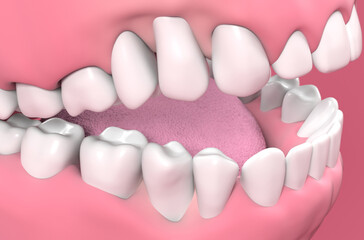 Gum recession - isometric view 3d illustration