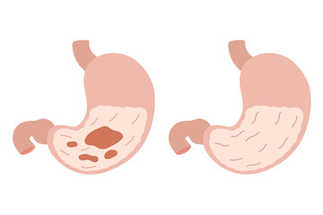 Cartoon Stomach. Healthy and ailing stomach, ulcer, tumor. Cartoon internal organs. Gastritis and inflammation. Improper diet, acid, infection. Stock vector illustration isolated on white background.