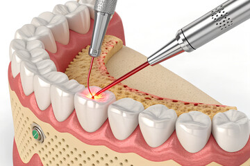 Advanced Dental Laser Treatment for Tooth Decay and Gum Health