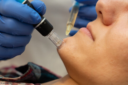 microneedling procedure