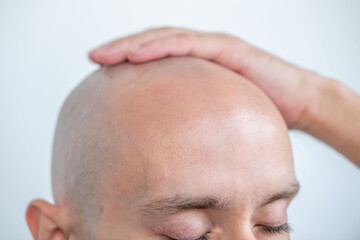 Fototapeta premium Young Bald man touching his head, eyes closed, bald patches on scalp, showing signs alopecia, healing touch, treatment hair loss, personal moment, stress relief