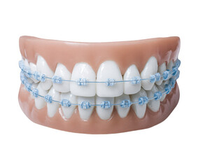 Closeup of a dental model showing teeth with blue ceramic braces, isolated on transparent background