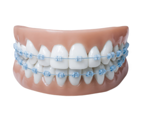 Closeup of a dental model showing teeth with blue ceramic braces, isolated on transparent background