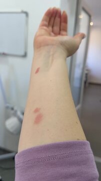 Show me your hand with three red spots, two insect bites, and a small burn.. burn bite on the hand