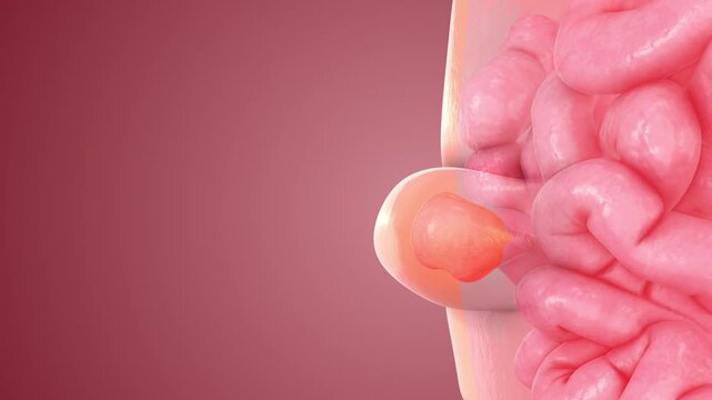 Medical Visualization of Human Abdominal Hernia Formation