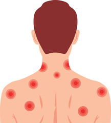 An illustration of a person with red welts on the back, indicating the characteristic rash of shingles (herpes zoster) infection