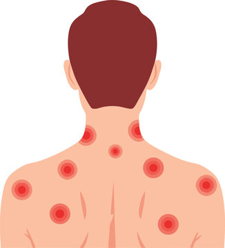 An illustration of a person with red welts on the back, indicating the characteristic rash of shingles (herpes zoster) infection