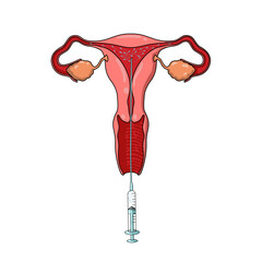 Illustration of Intrauterine Insemination, IUI treatment, Sperm Donor, pregnancy planning, egg and sperm cells, vector illustration for medical posters, clinics, and education