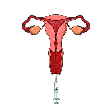 Illustration of Intrauterine Insemination, IUI treatment, Sperm Donor, pregnancy planning, egg and sperm cells, vector illustration for medical posters, clinics, and education