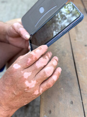 Vitiligo skin hands holding smart phone.