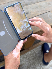 Male hands vitiligo using smartphone closeup.