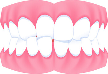 Full mouth teeth - Crossbite illustration transparent design. Dental care concept.