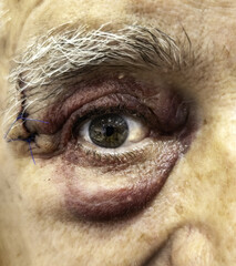 Older man hit eye