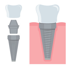 Dental implant. Screw prosthesis, Illustration of dental implantation,orthodontic dental implantation