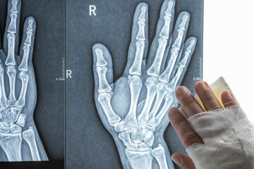 X-ray film and a man with wrapped hand