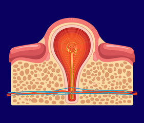A large periapical abscess illustration, showing a severe infection at the root apex of a tooth with pus formation and bone destruction against a dark background	