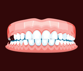 Illustration of the lower jaw, showing a full denture plate over the gums, representing a common tooth replacement option	