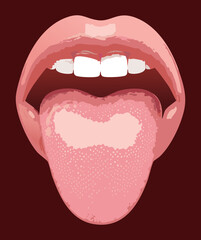 Anatomical View of the Tongue Highlighting the Location of the Palatine and Lingual Tonsils  © firstcolor