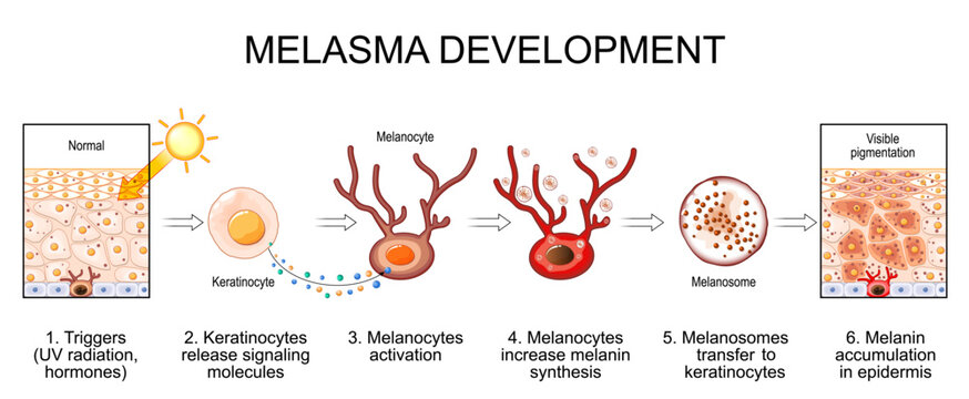 Melasma development. Melanocytes and Visible pigmentation in human skin