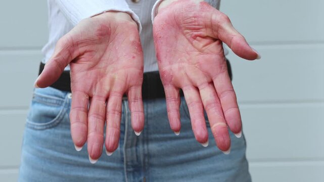 Effective ways to manage eczema and psoriasis at home with simple treatments and lifestyle changes