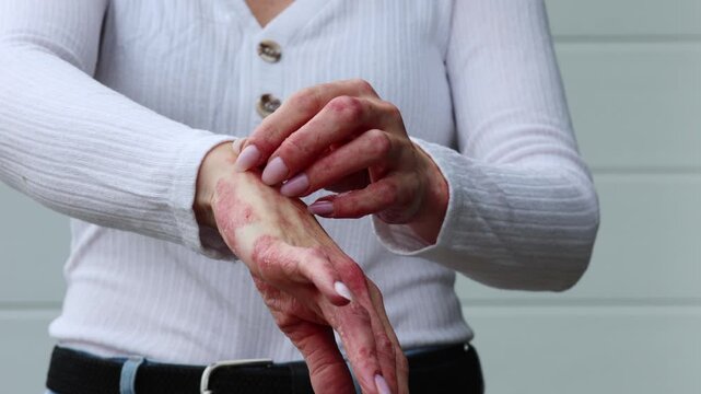 Skin care tips for managing eczema, psoriasis, and dermatitis at home