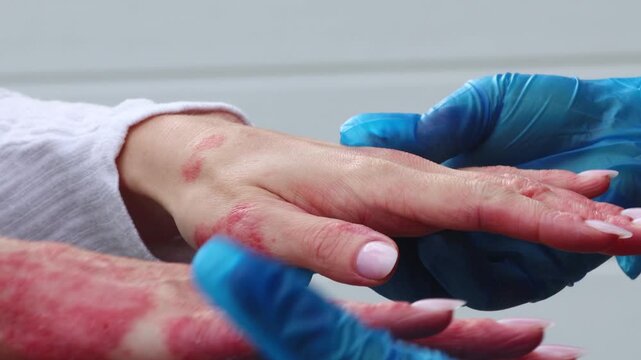 Skin problems treatment for eczema and dermatitis on hand at dermatology clinic